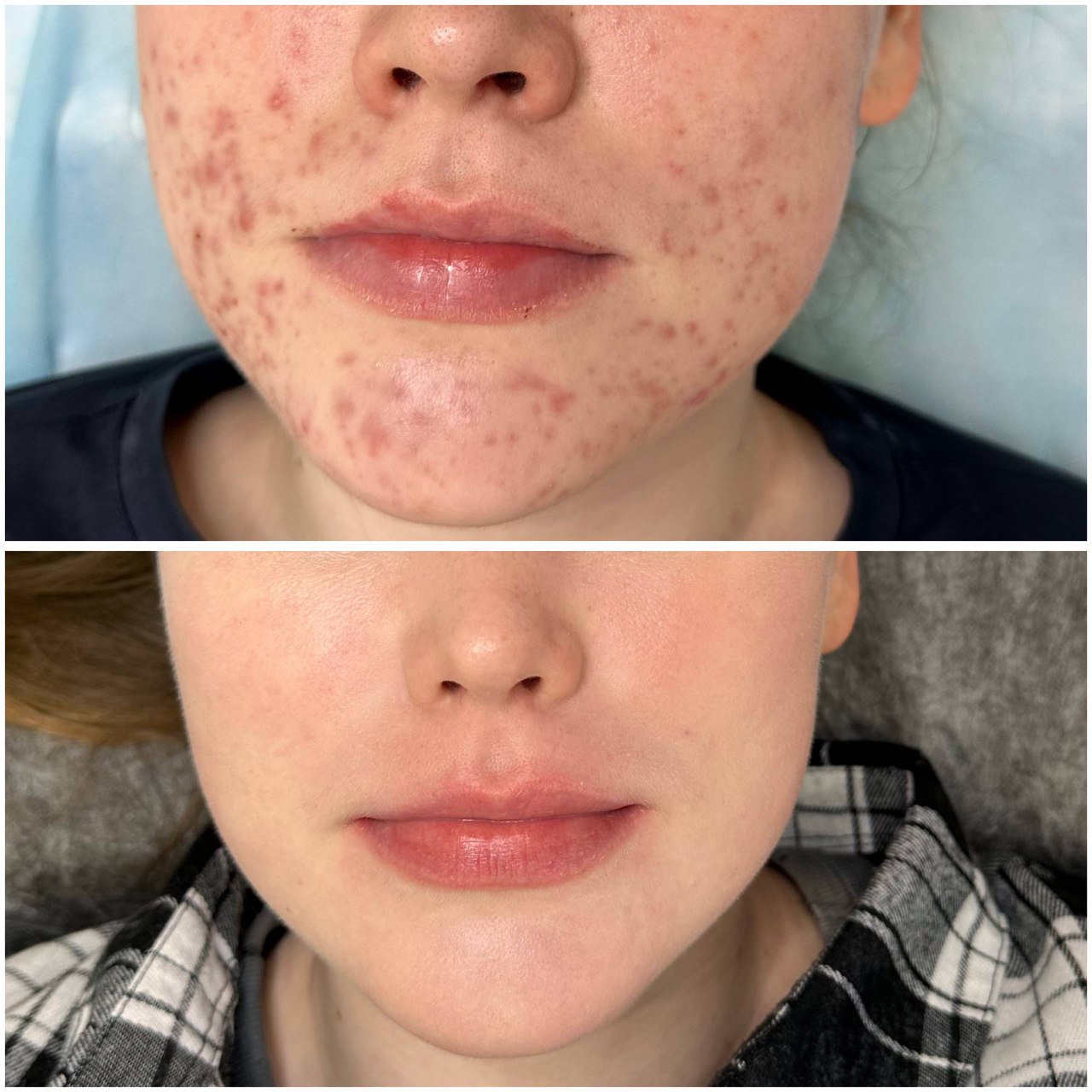 Результат лечения 1