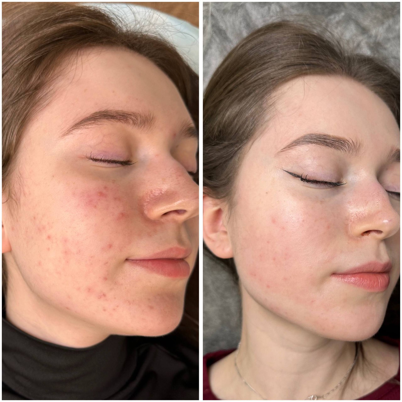 Результат лечения 2