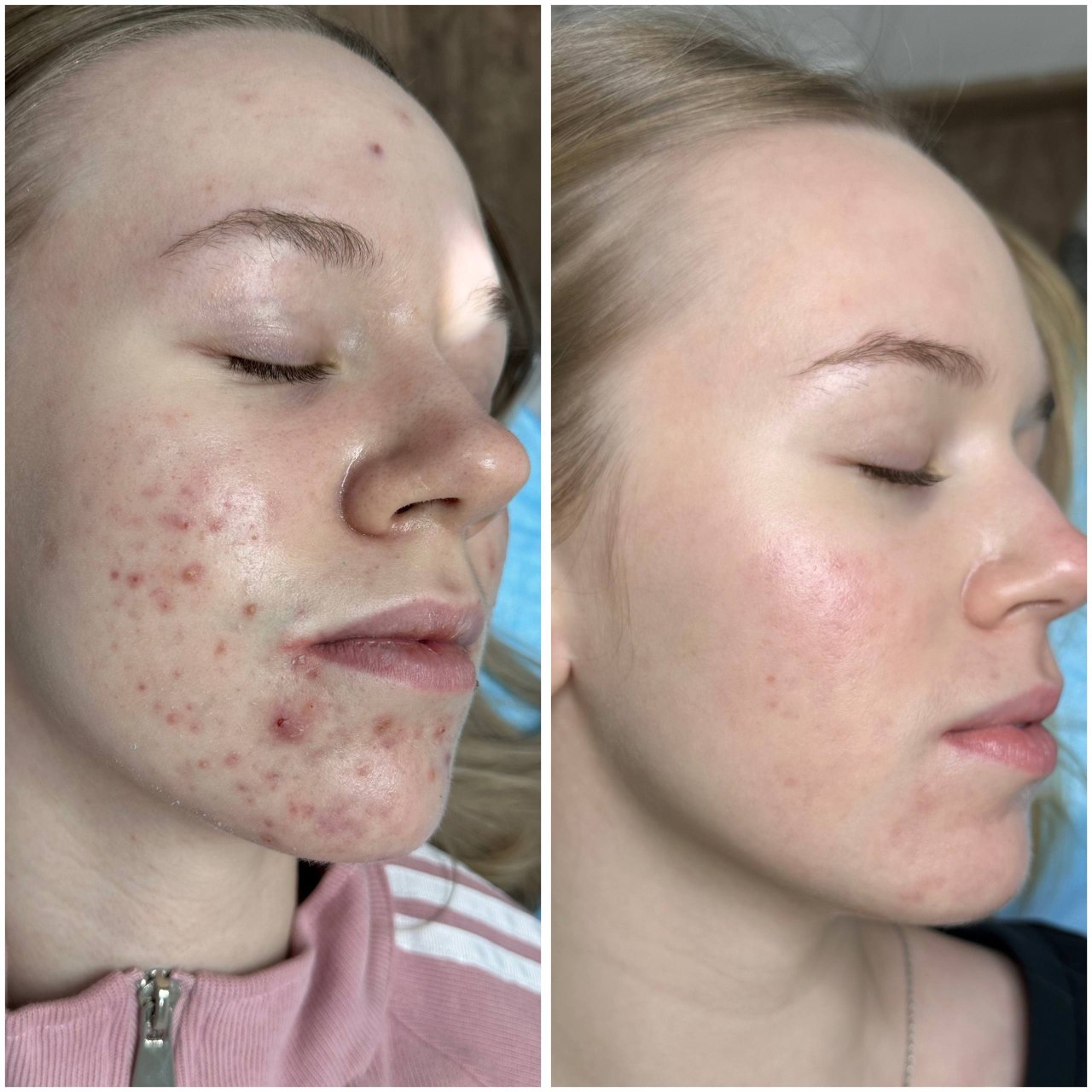 Результат лечения 3