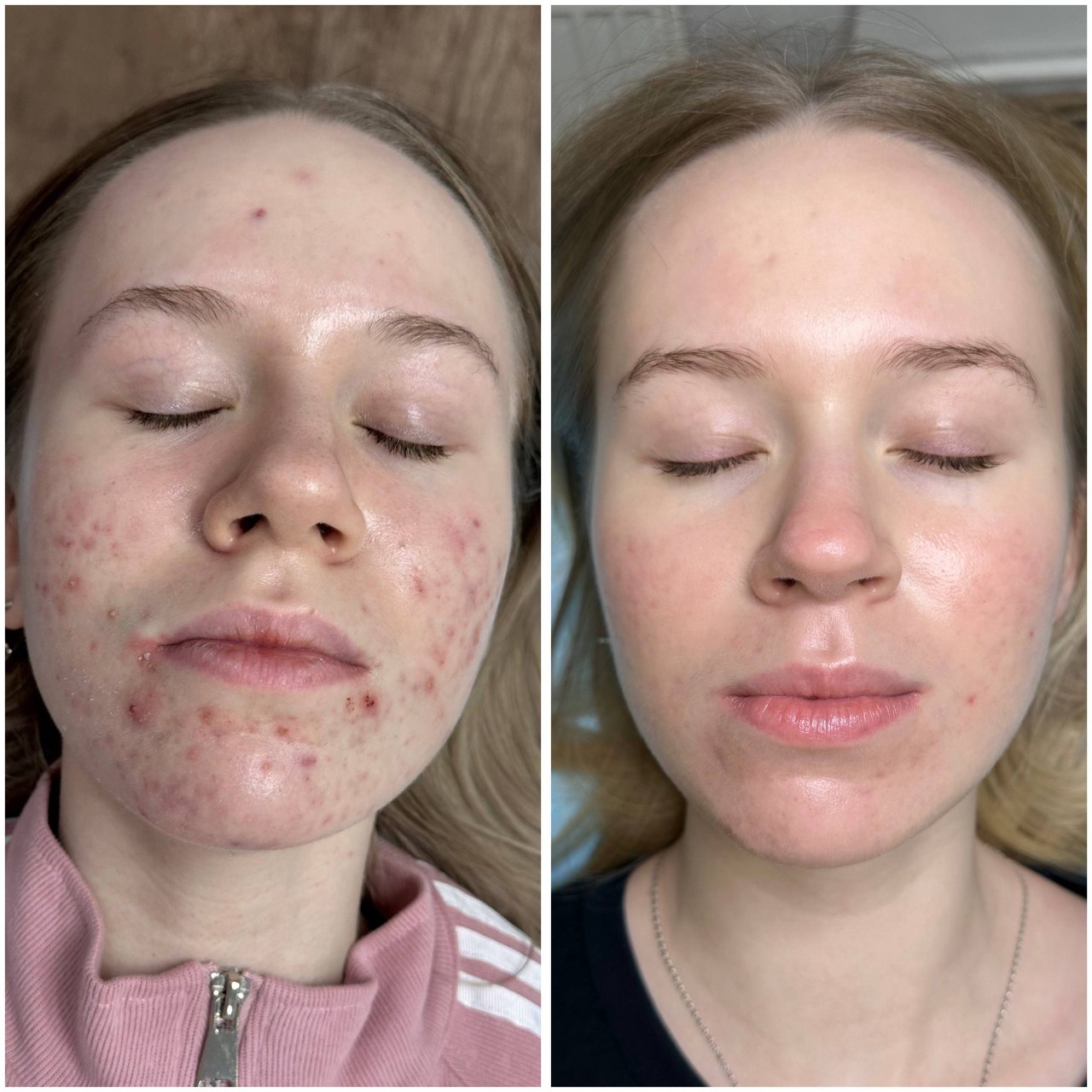 Результат лечения 4