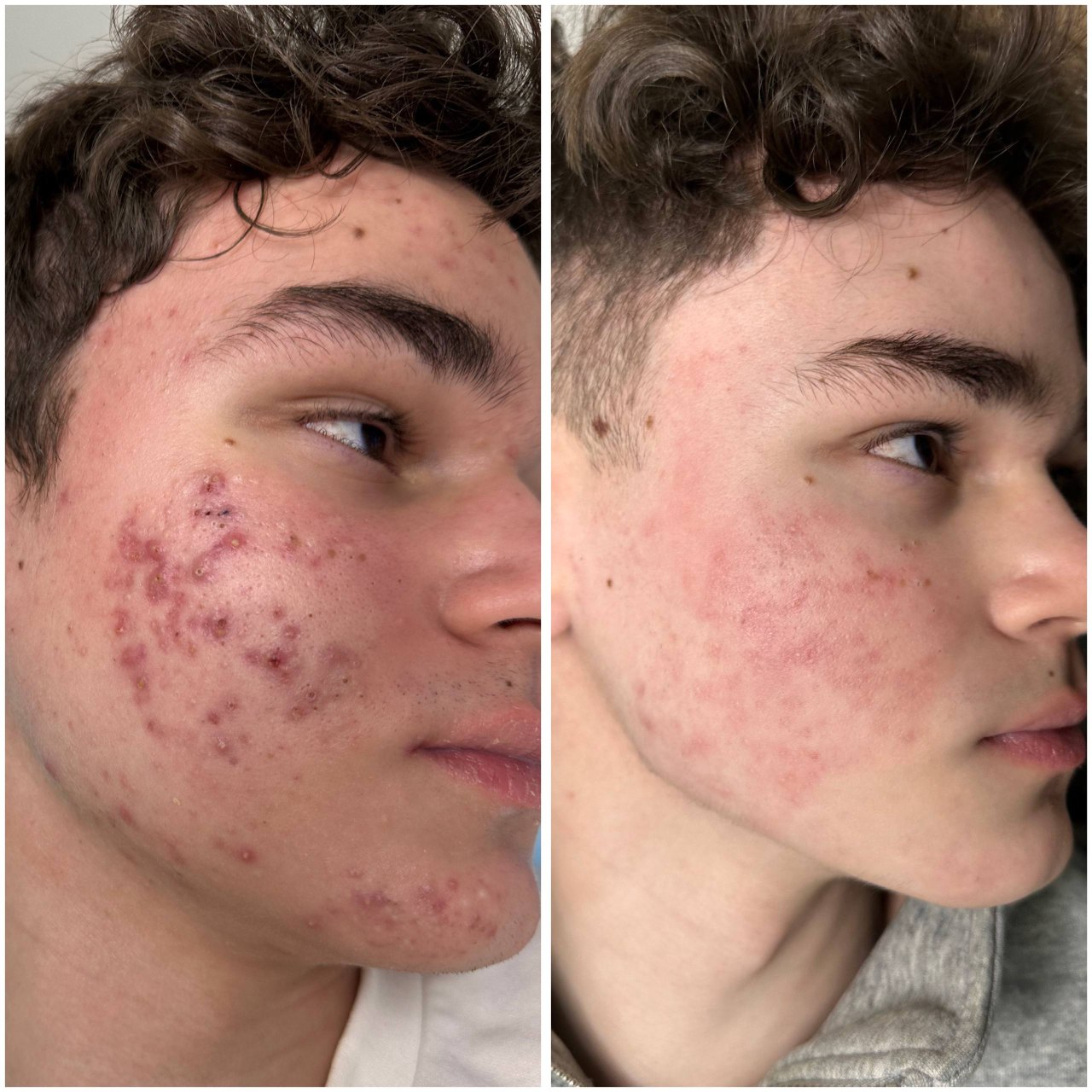 Результат лечения 6